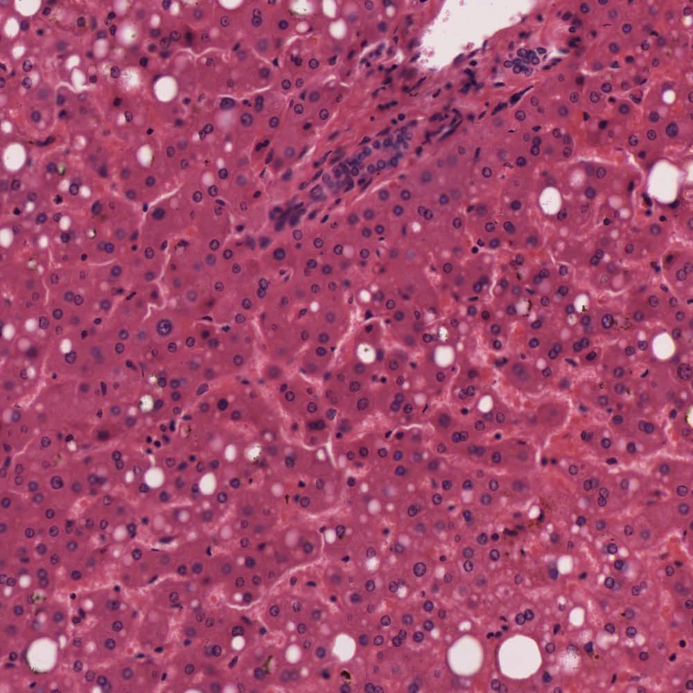 Liver with Fat Globules