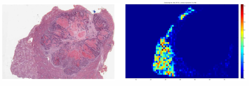Liver with Fat Globules