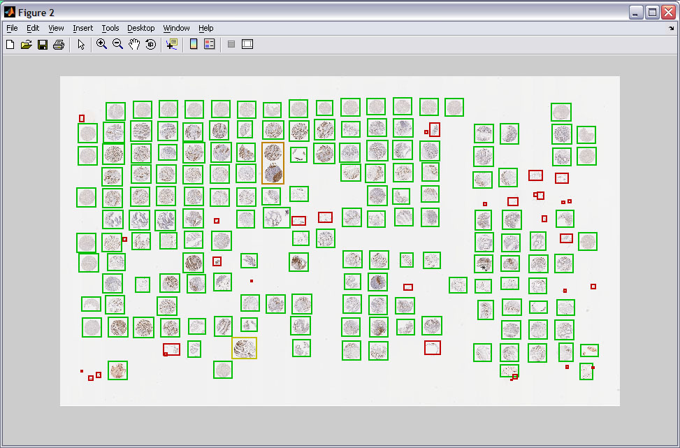 Automatic Image Analysis on Tissue MicroArray Cores