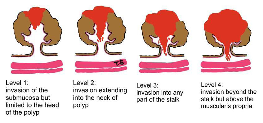 Haggitt levels of invasion in polypoid carcinomas