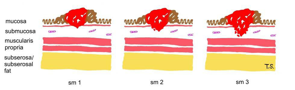 Kikuchi levelsof submucosal infiltration
