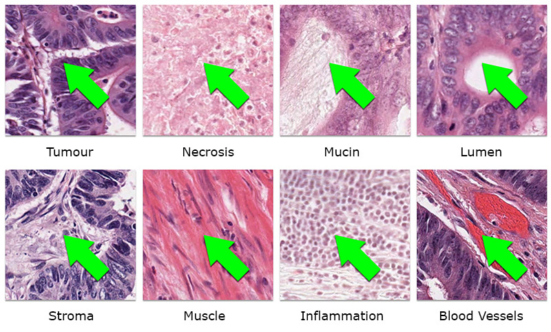 Bowel cancer tissue types