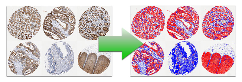 Automatic Image Analysis on Tissue MicroArray Cores