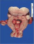 fibroiduterus.jpg